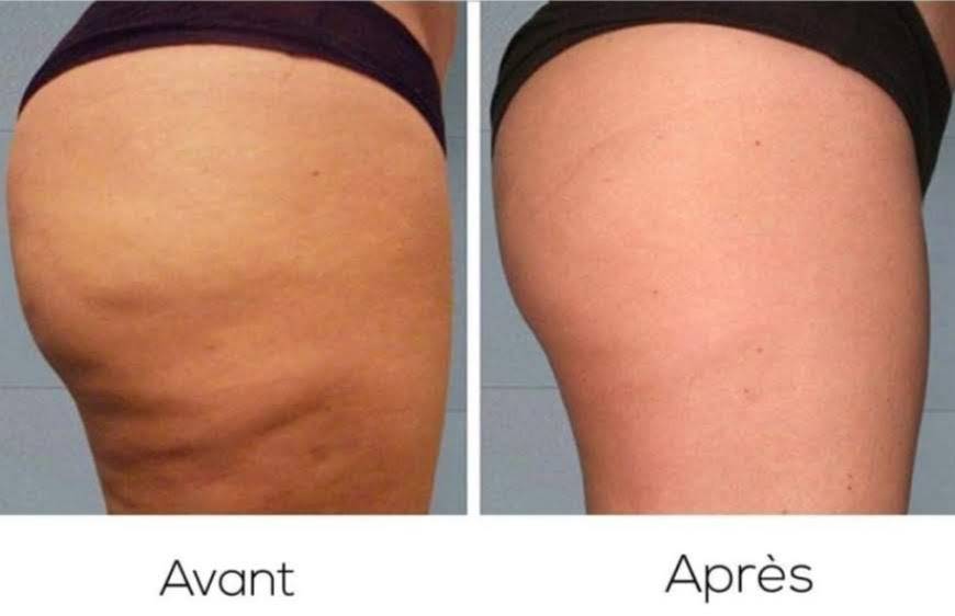 Lipocavitation Cagnes sur mer