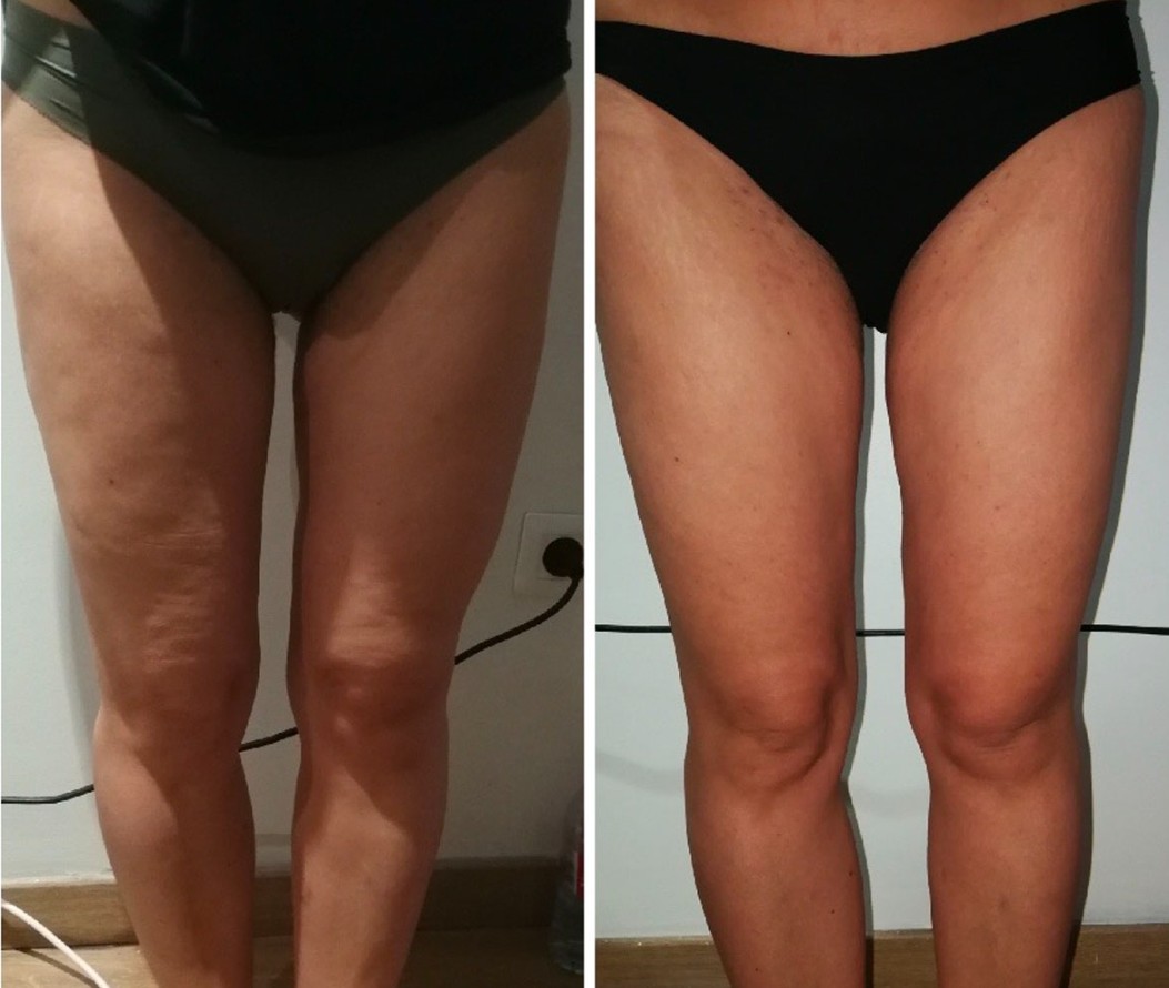 Lipocavitation Cagnes sur mer