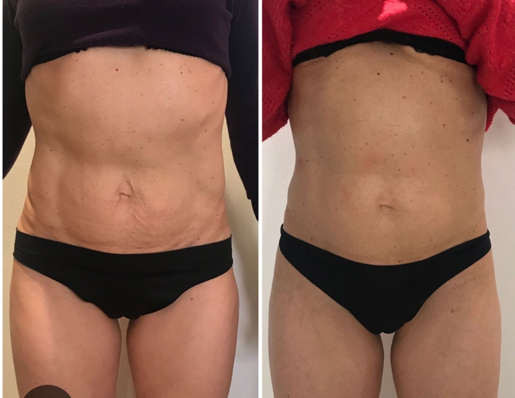 Lipocavitation Cagnes sur mer